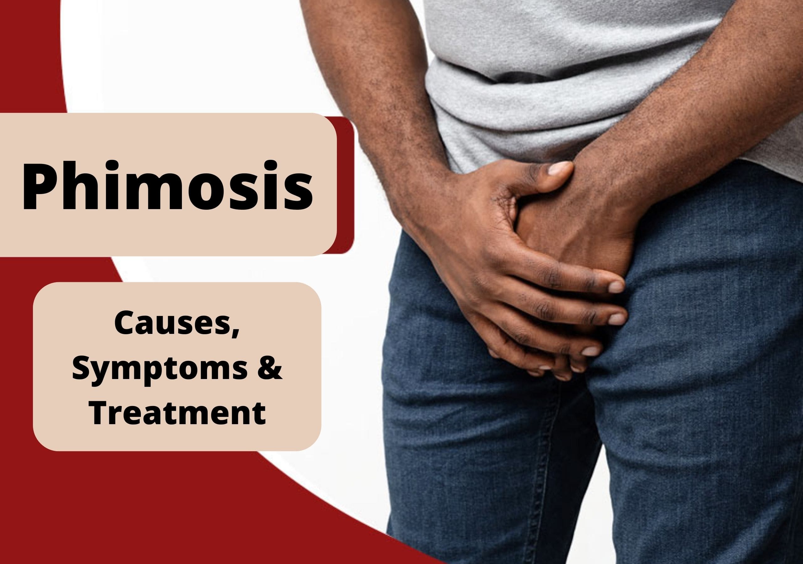 Phimosis Treatment in Pune Archives - UroLife